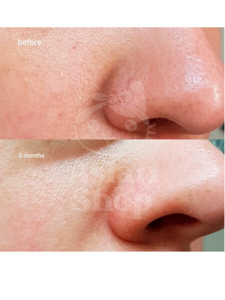 COSRX BHA Blackhead Power Liquid modo de uso textura aplicación rostro